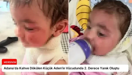 Adana’da Kahve Dökülen Küçük Aden’in Vücudunda 2. Derece Yanık Oluştu